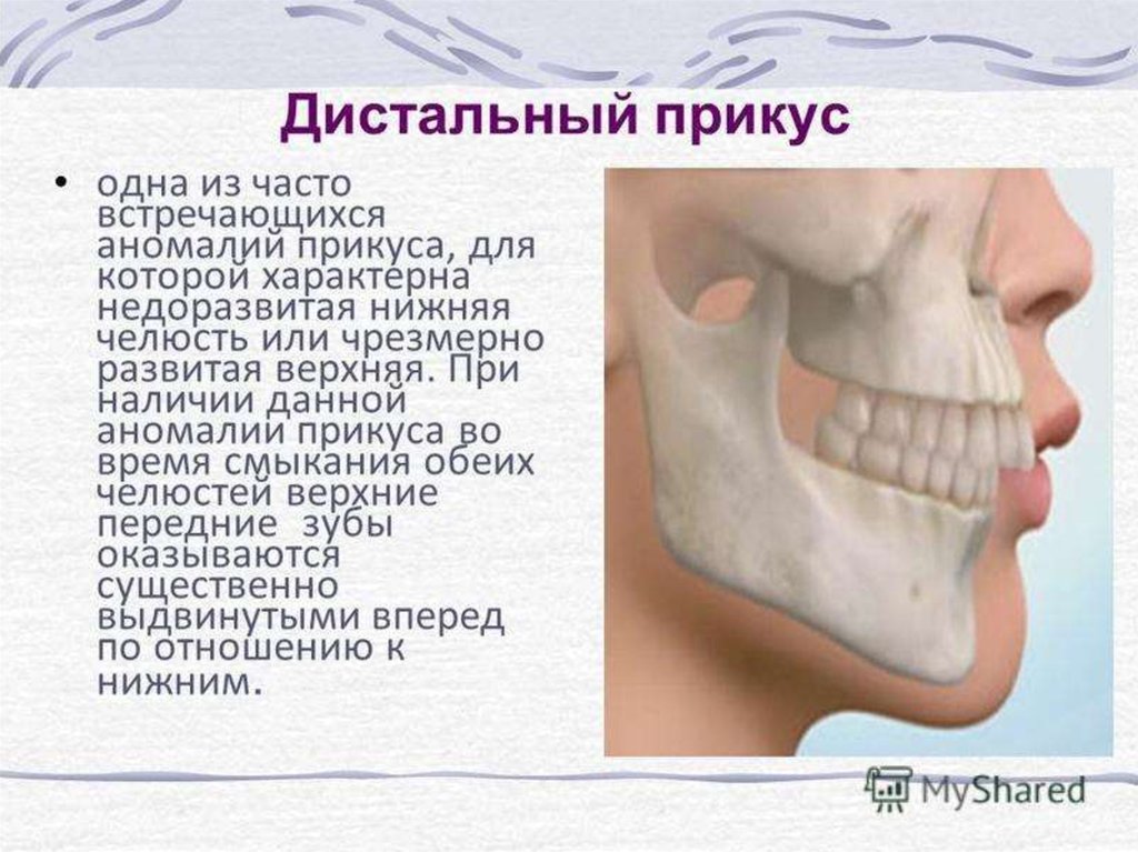 Почему нижняя челюсть. Дистальное соотношение челюстей. Дистальный (прогнатический) прикус. Дистальный прикус прикус. Дистальный прикус нижняя челюсть.