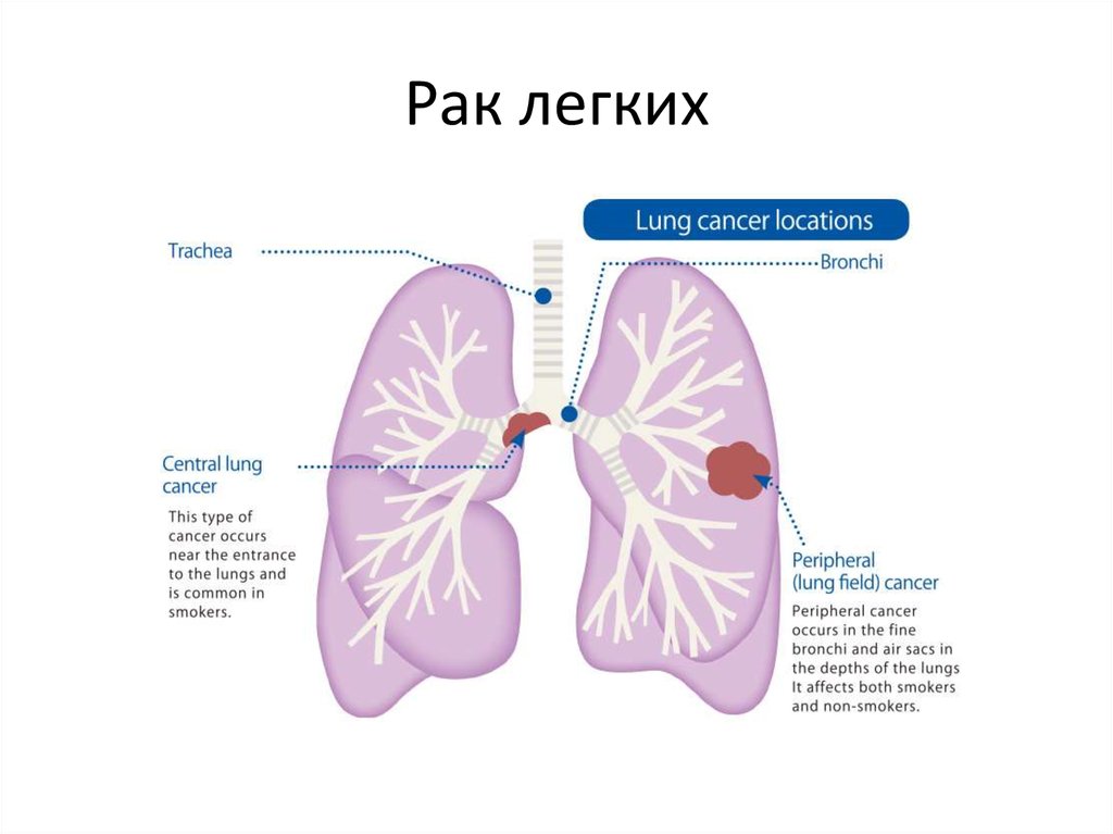 Рак легкого рисунок