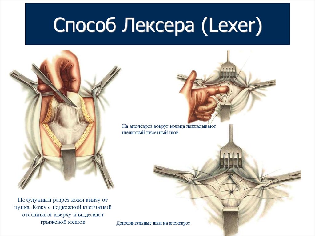 Способы пластики грыж