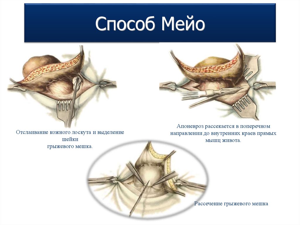 Пластика грыж. Пластика по Мейо при пупочной грыже схема. Пупочная грыжа операция по Мейо.