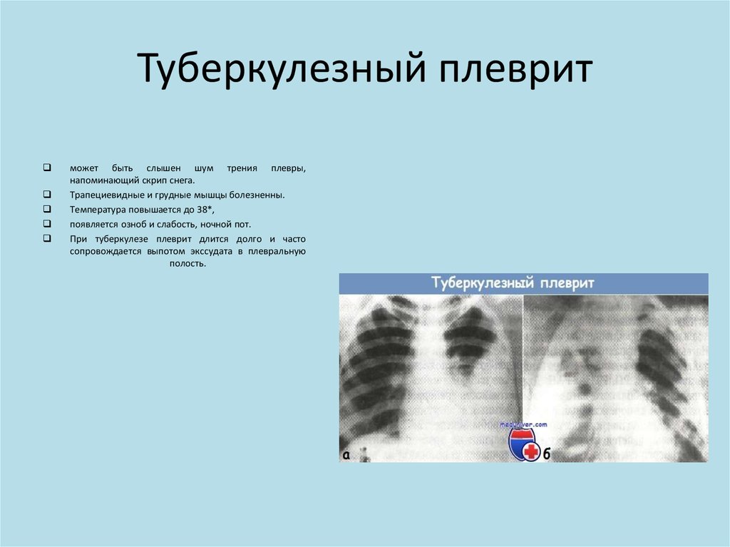 Описание плеврита