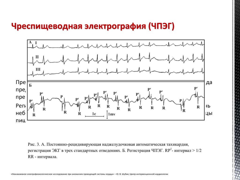 Эфи. Чреспищеводная ЭКГ. Чреспищеводная электрокардиостимуляция предсердий. Чреспищеводная стимуляция предсердий. Чреспищеводная электрокардиография (ЭКГ).