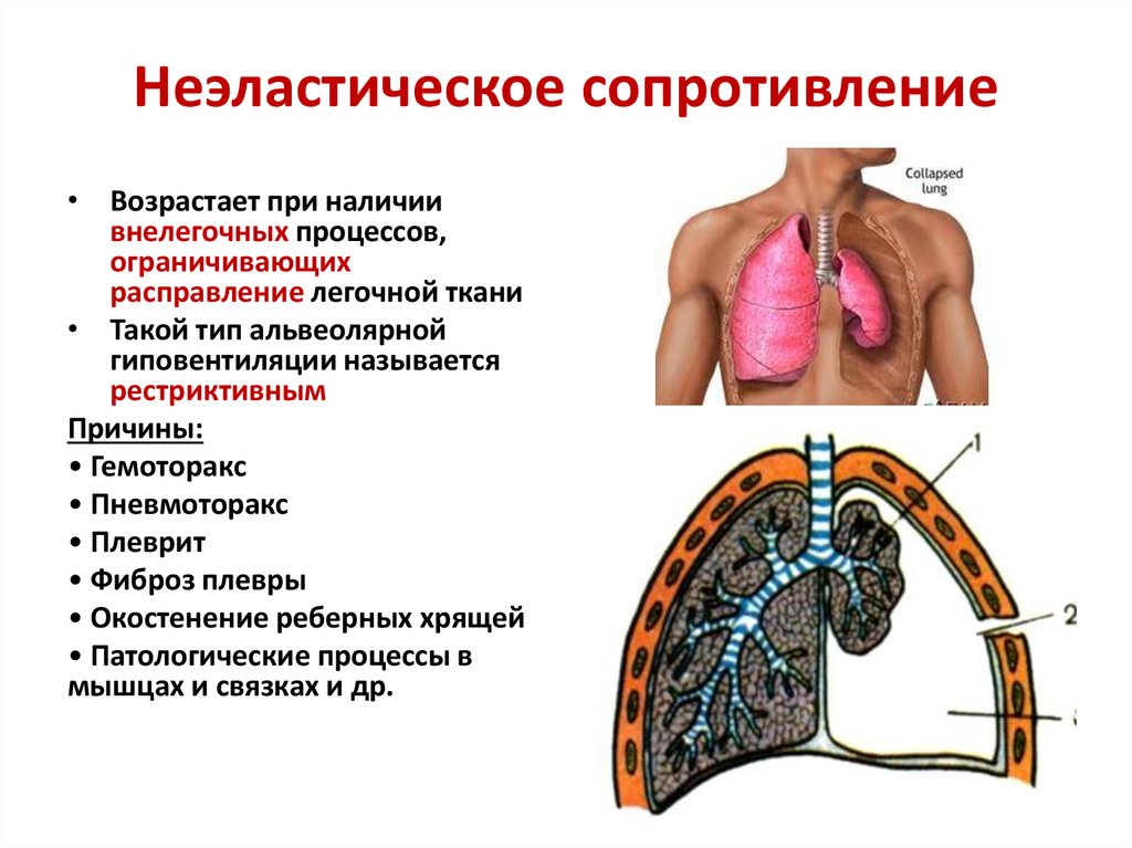 Презентация пневмоторакс и гемоторакс