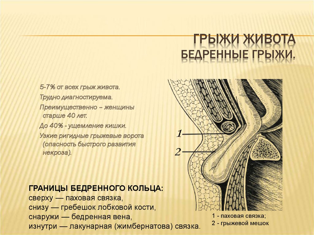 Бедренная грыжа. Грыжевое содержимое бедренной грыжи. Грыжа живота классификация.