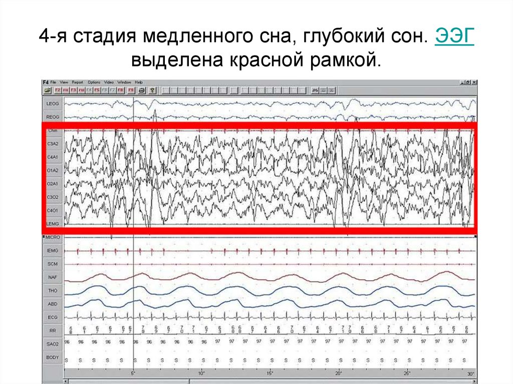 Нарисовать схему стадий сна по данным ээг