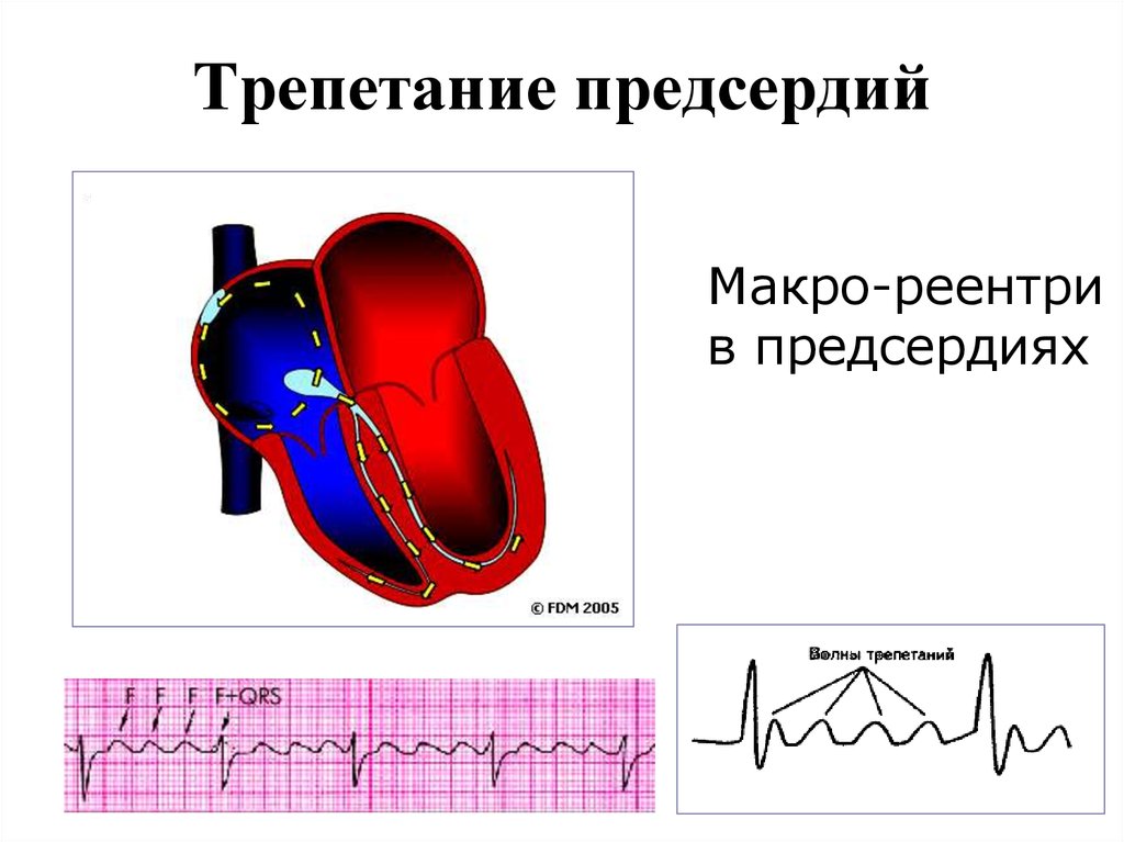 Трепетание предсердий