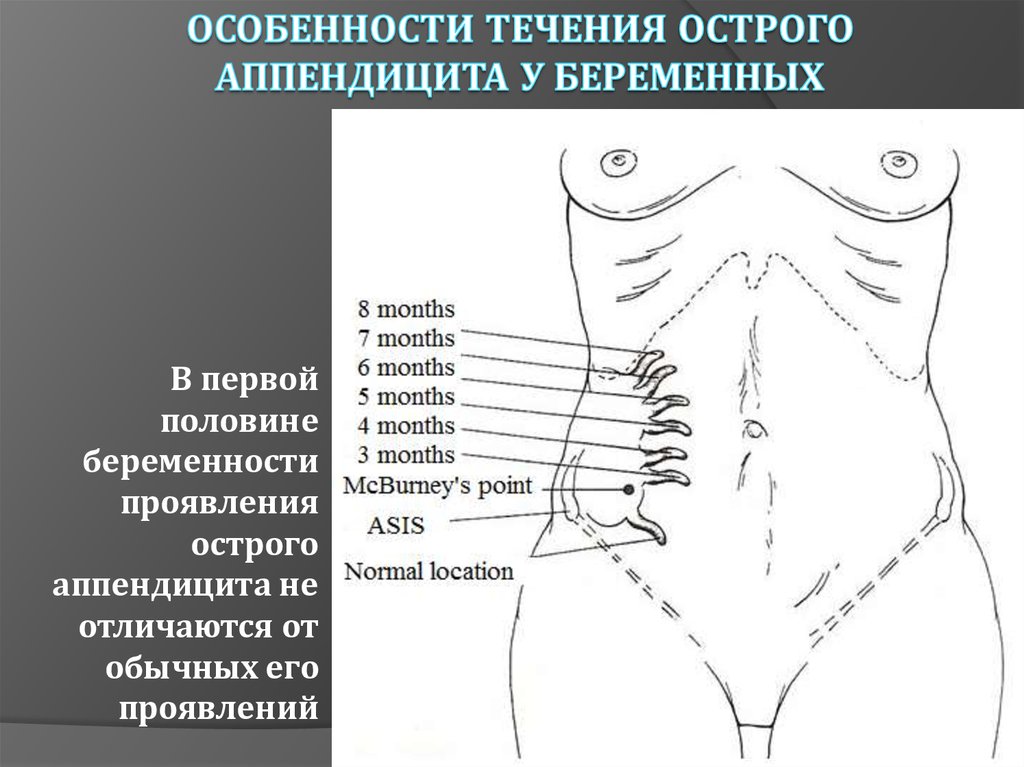 Место где болит при аппендиците на картинке