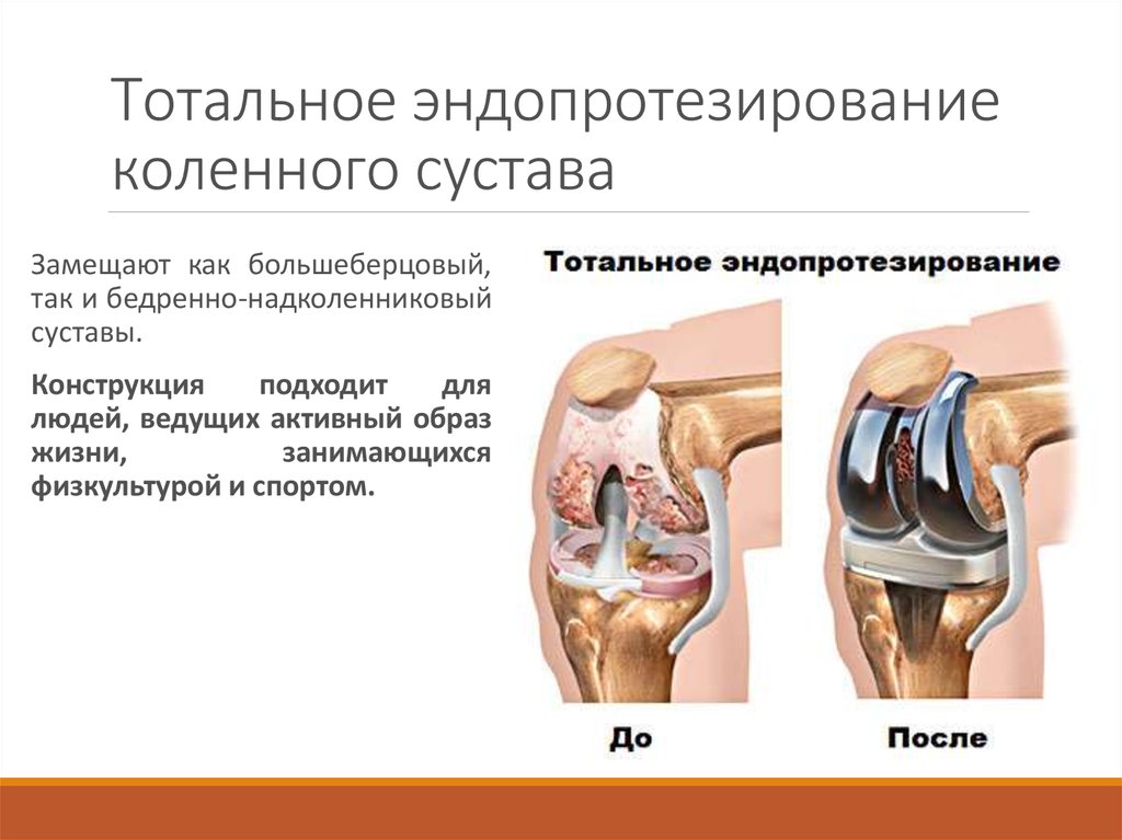 Операции на коленном суставе стоимость. Тотальное эндопротезирование коленного сустава. Тотальное эндопротезирование коленного сустава техника выполнения. Эндопротезирование коленного сустава схема. Эндопротез коленного сустава Zimmer.