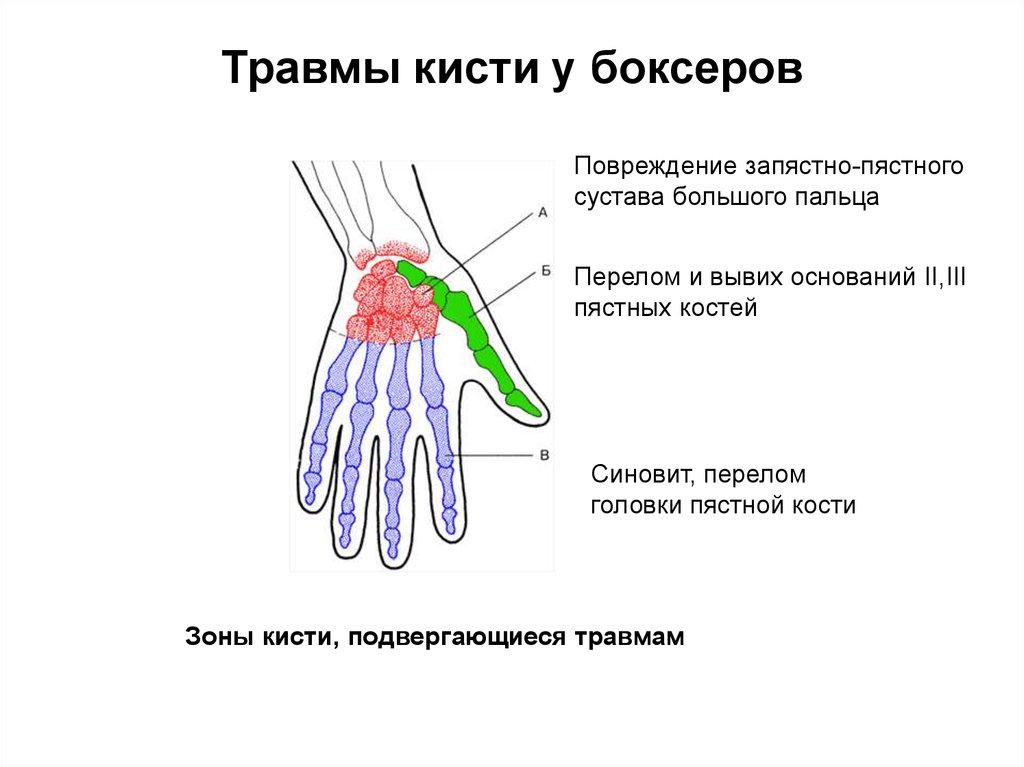 Запястьев или запястий. Ушиб запястно пястного сустава.