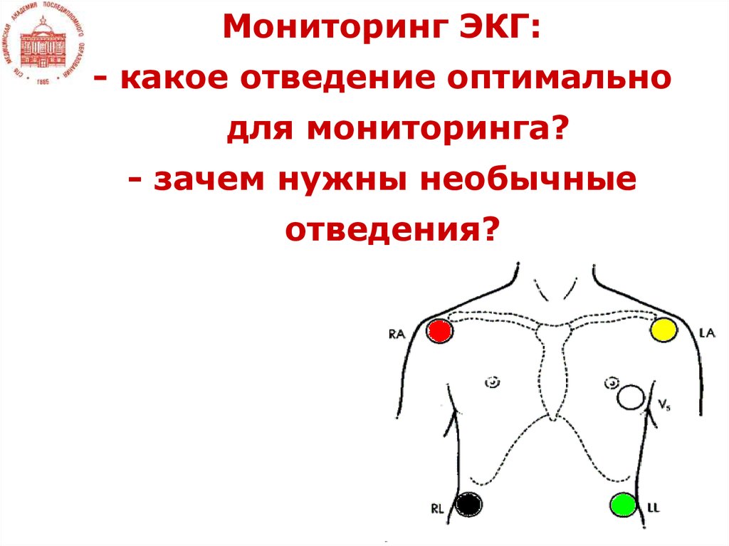 Датчики холтера схема. ЭКГ электроды 5 электродов. Схема наложения электродов миокард Холтер 2. Миокард Холтер схема наложения электродов. Холтер ЭКГ схема наложения электродов.