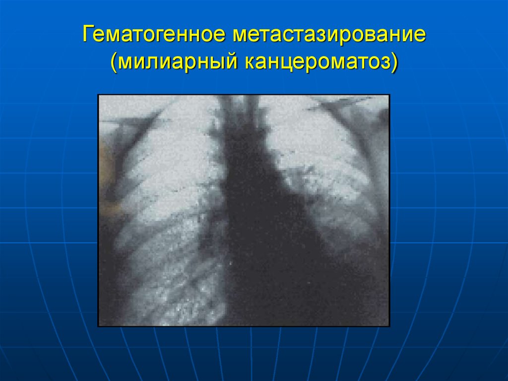 Карциноматоз. Милиарный карциноматоз. Милиарный карциноз легких. Милиарный канцероматоз.