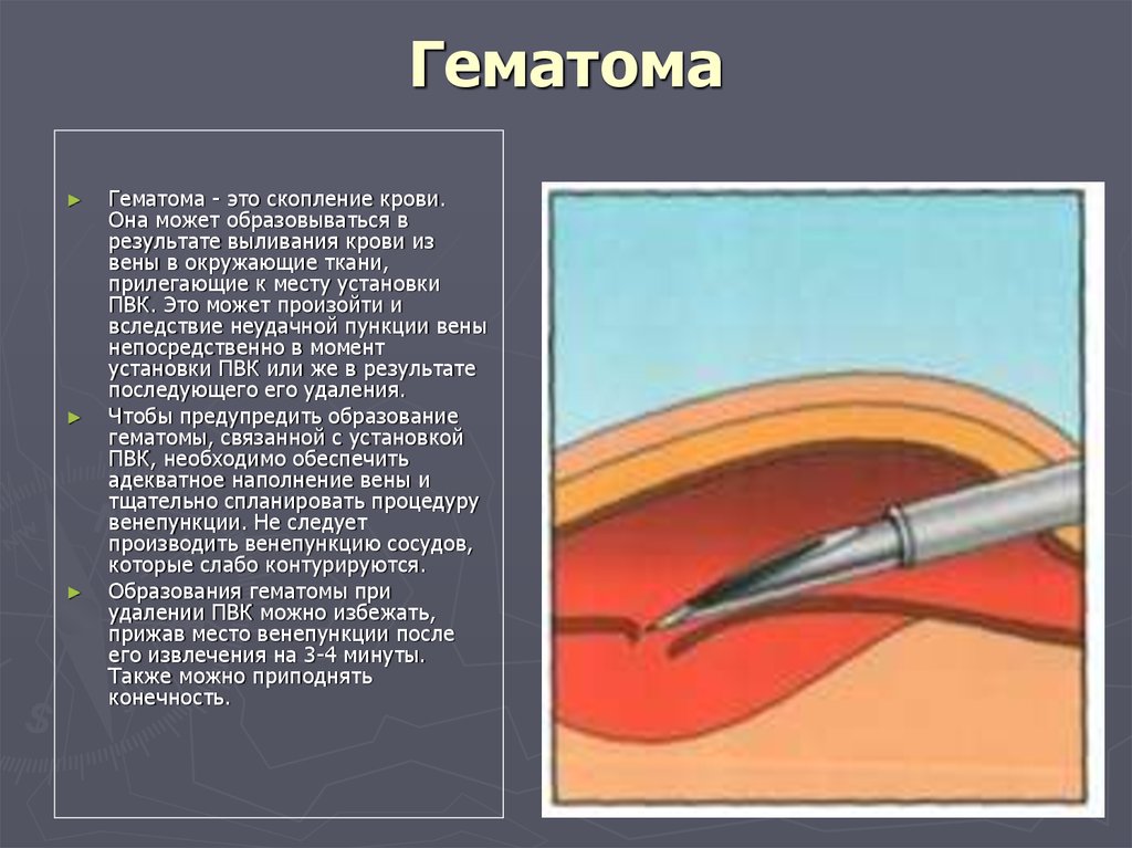 Лечение после удара. Причины образования гематом. Гематома это скопление крови в.