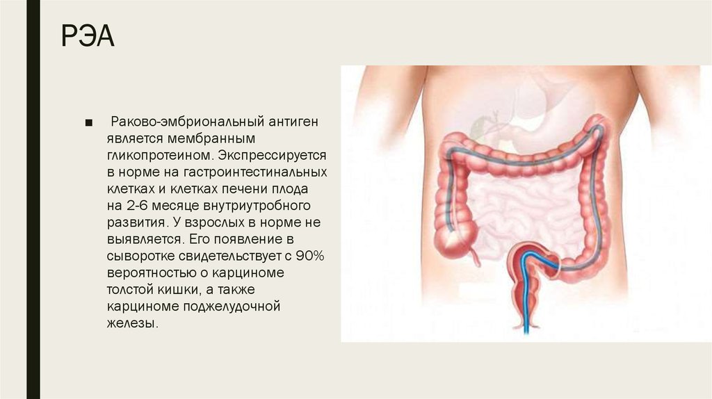 Что означает раковый антиген. Раково-эмбриональный антиген (РЭА). Раковоэмбриональный антиген норма. Ранний эмбриональный антиген. Раковый эмбрион антиген что это.