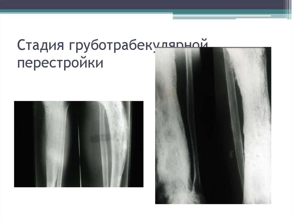 Деформация костей. Груботрабекулярная перестройка. Груботрабекулярная перестройка кости рентген.