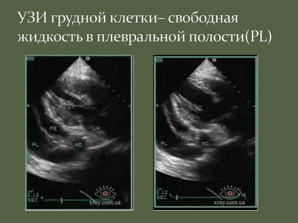 Узи плевральной полости. Гидроторакс УЗИ плевральных полостей. Свободная жидкость в плевральной полости на УЗИ. Ультразвуковое исследование органов грудной клетки.