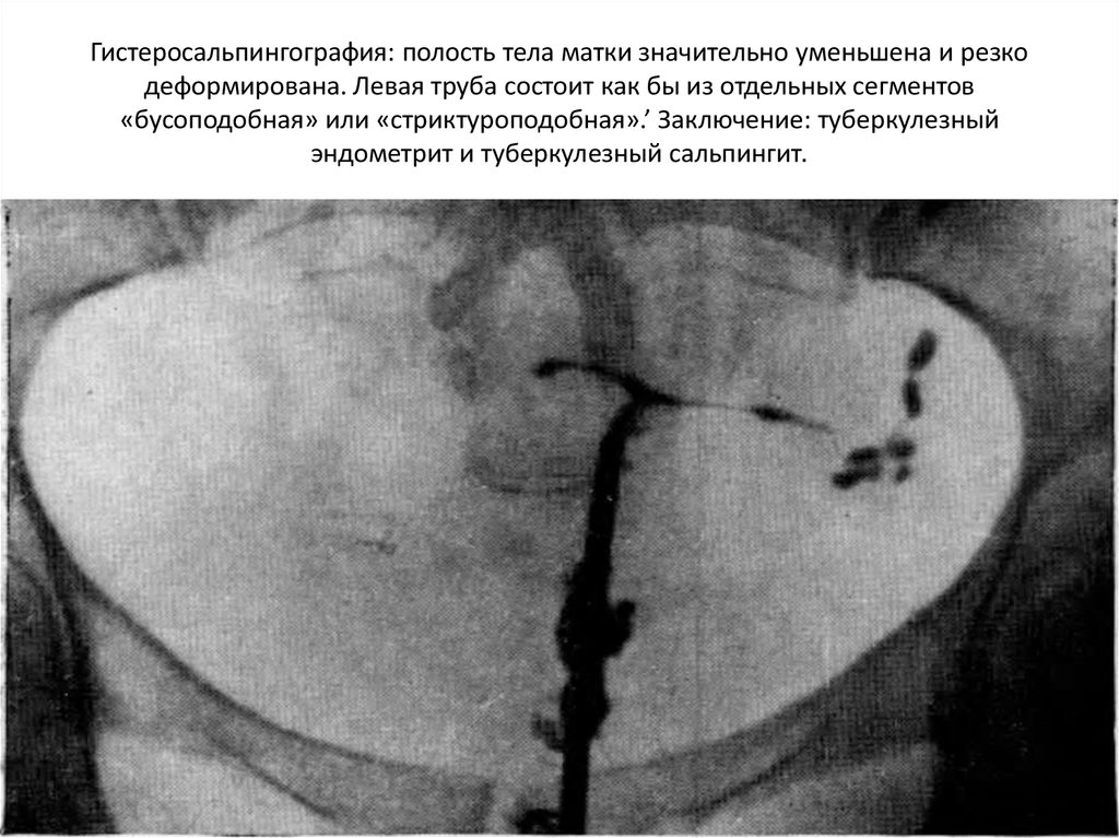 Туберкулез половых органов у женщин. Генитальный туберкулез гистеросальпингография. Гистеросальпингография аденомиоз.