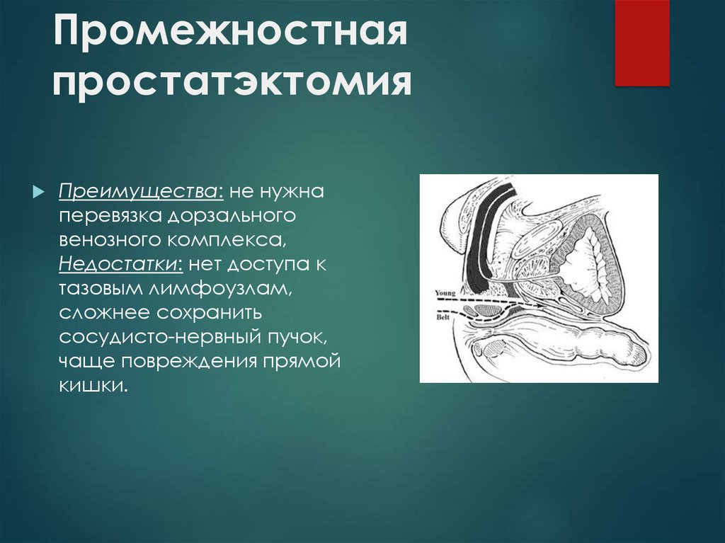 Радикальная простатэктомия. Брюшно-промежностная экстирпация (операция Кеню-Майлса). Промежностная простатэктомия. Радикальная промежностная простатэктомия что это. Брюшно-промежностная экстирпация прямой кишки.