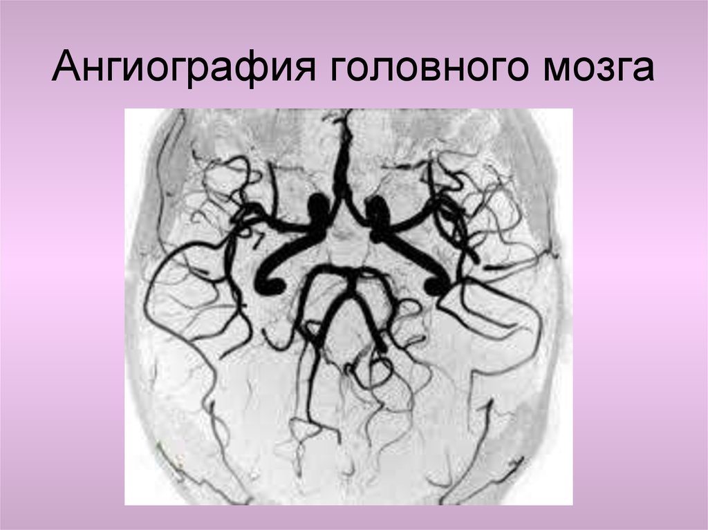 Ангиография головного мозга. Ангиография сосудов головного мозга. Ангиография головного ангиография мозга. Контрастная ангиография сосудов головного мозга. Кт ангиография головного мозга.