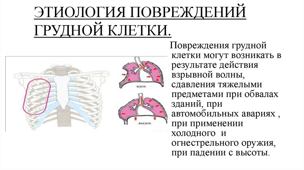 Травмы грудной клетки