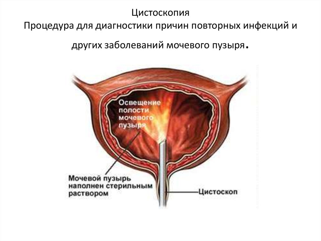 Цистоскопия мочевого пузыря