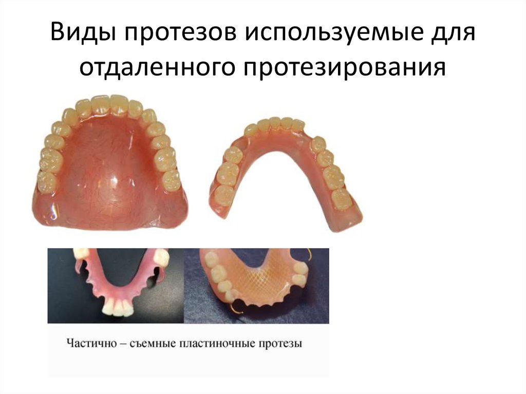 Зубы протезирование виды отзывы