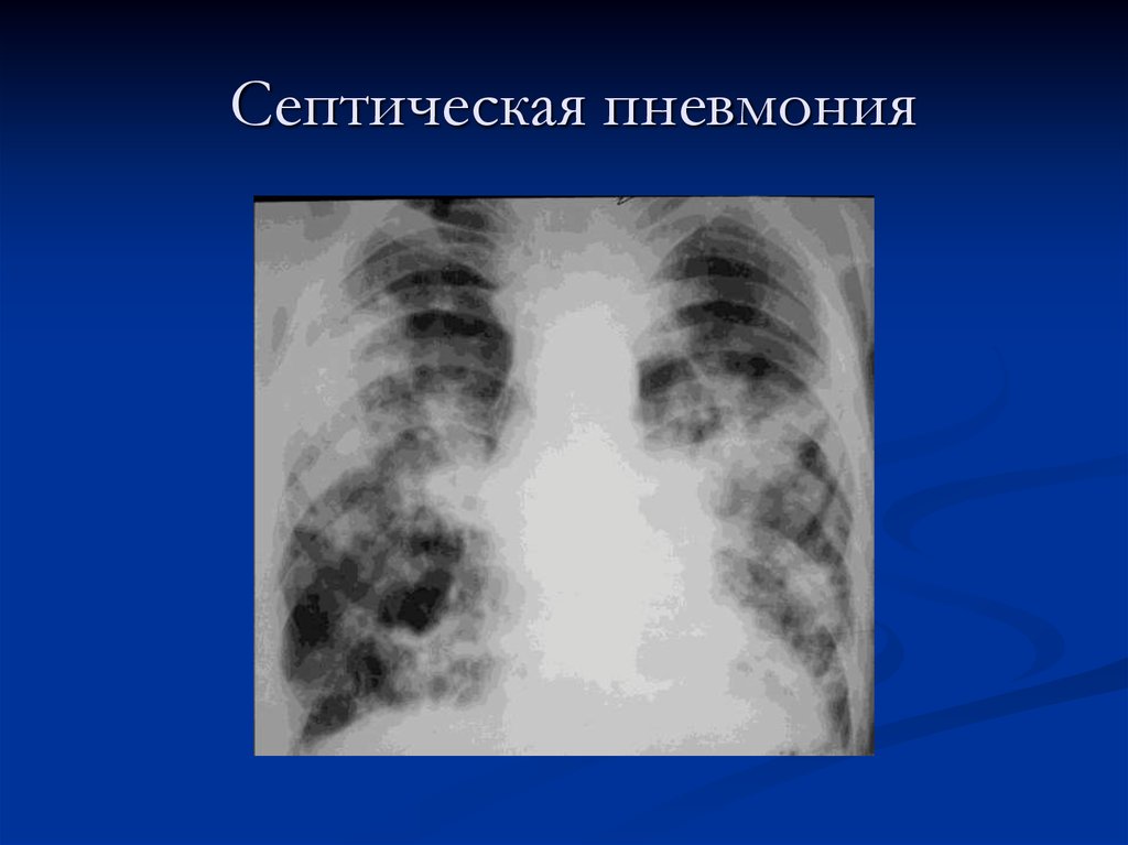 Деструктивная пневмония. Абсцедирующая (очаговая, септическая) пневмония. Рентген септической метастатической пневмонии.. Септическая пневмония рентген. Метастатический медиастинит это.