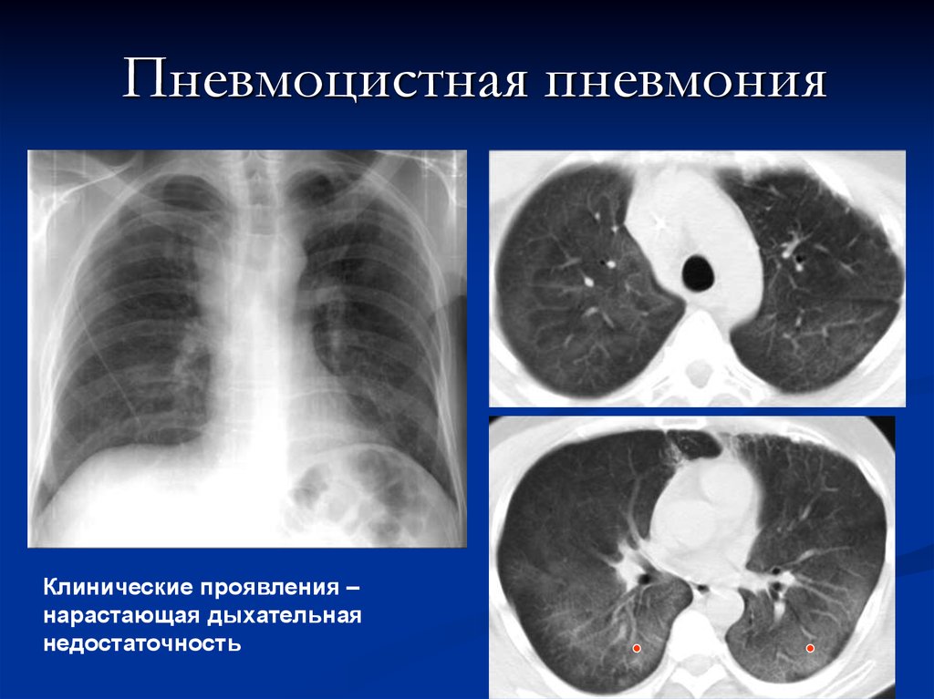 Пневмоцистная пневмония. Пневмоцистная пневмония и пневмоцистоз. Пневмоцистная интерстициальная пневмония кт. Пневмоцистная пневмония рентген. Пневмоцистная пневмония клинические симптомы.