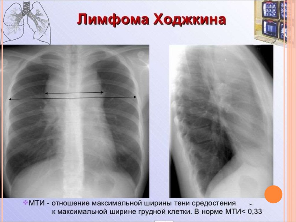 Лимфома. Лимфома Ходжкина рентген. Лимфома средостения рентген. Лимфогранулематоз средостения кт. Неходжкинская лимфома средостения рентген.