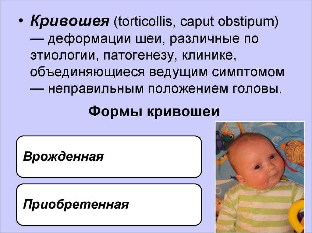 Кривошея у новорожденных признаки. Классификация кривошеи. Нейрогенная врожденная кривошея.