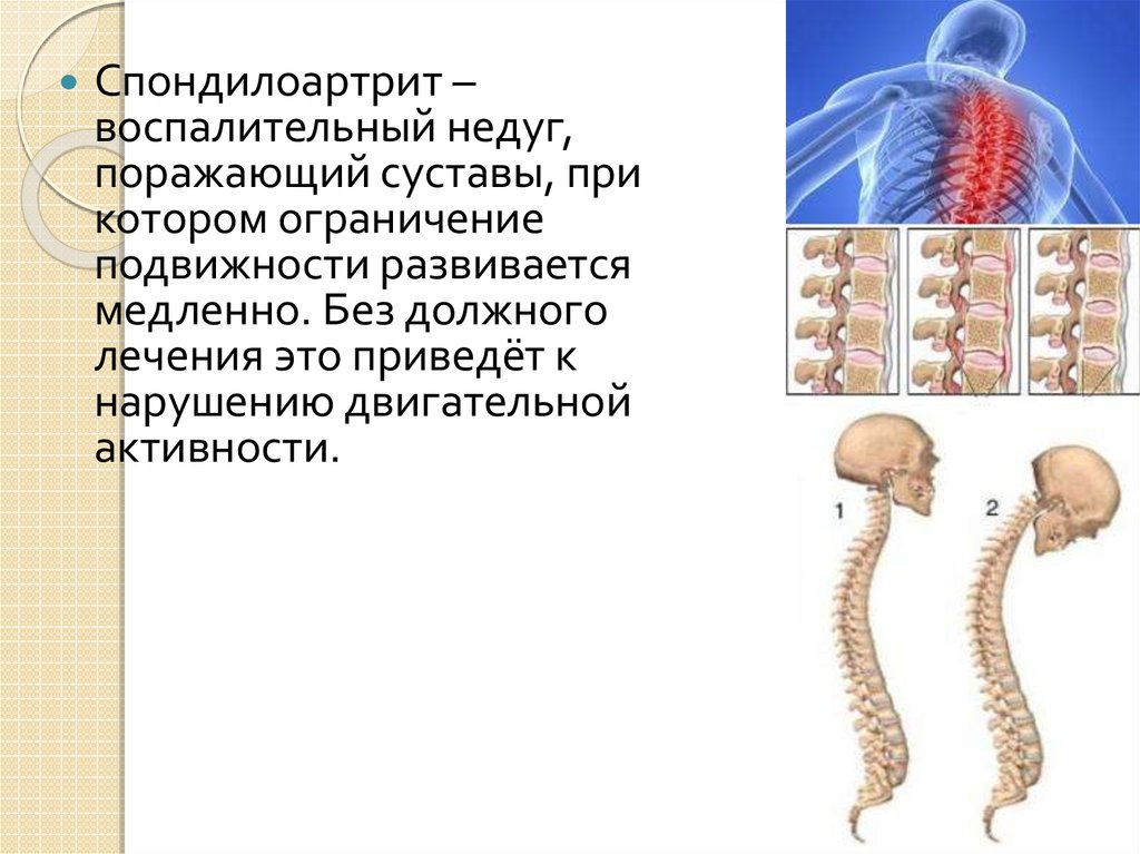 Спондилоартрит. Реактивный спондилоартрит. Ревматоидный спондилоартрит. Аутоиммунный спондилоартрит.