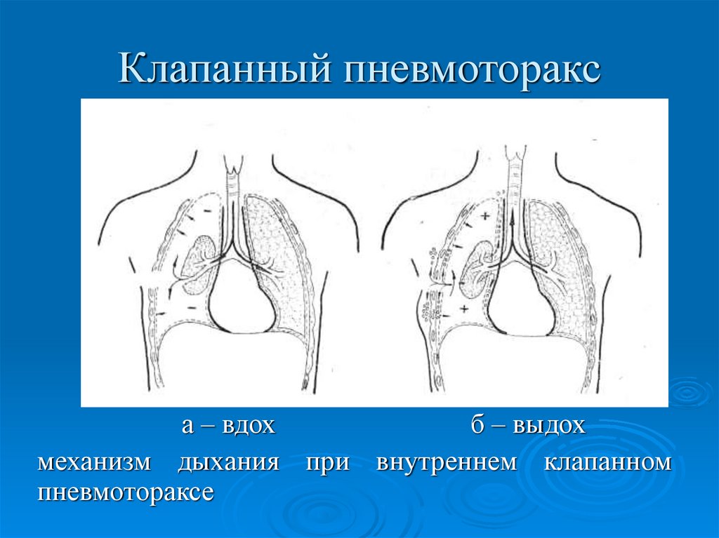 Клапанный пневмоторакс. Клапанный внутренний пневмоторакс всегда характерен при. Клапанный пневматорок. Клапоновый пневмоторакс.