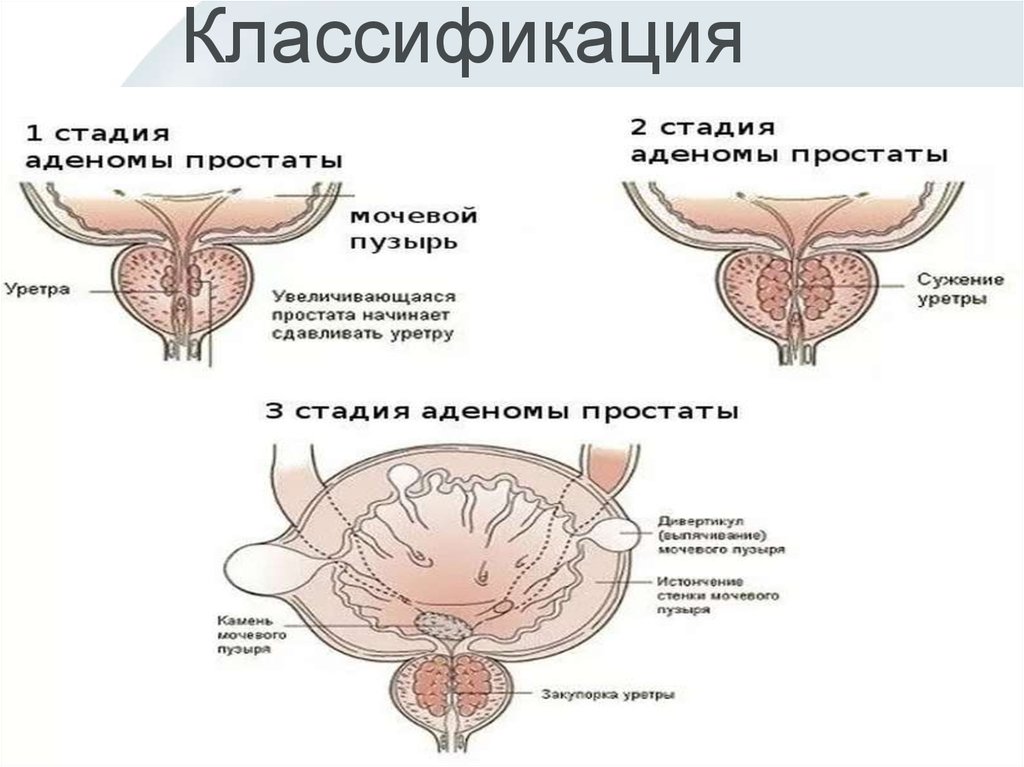 Уретра предстательной железы