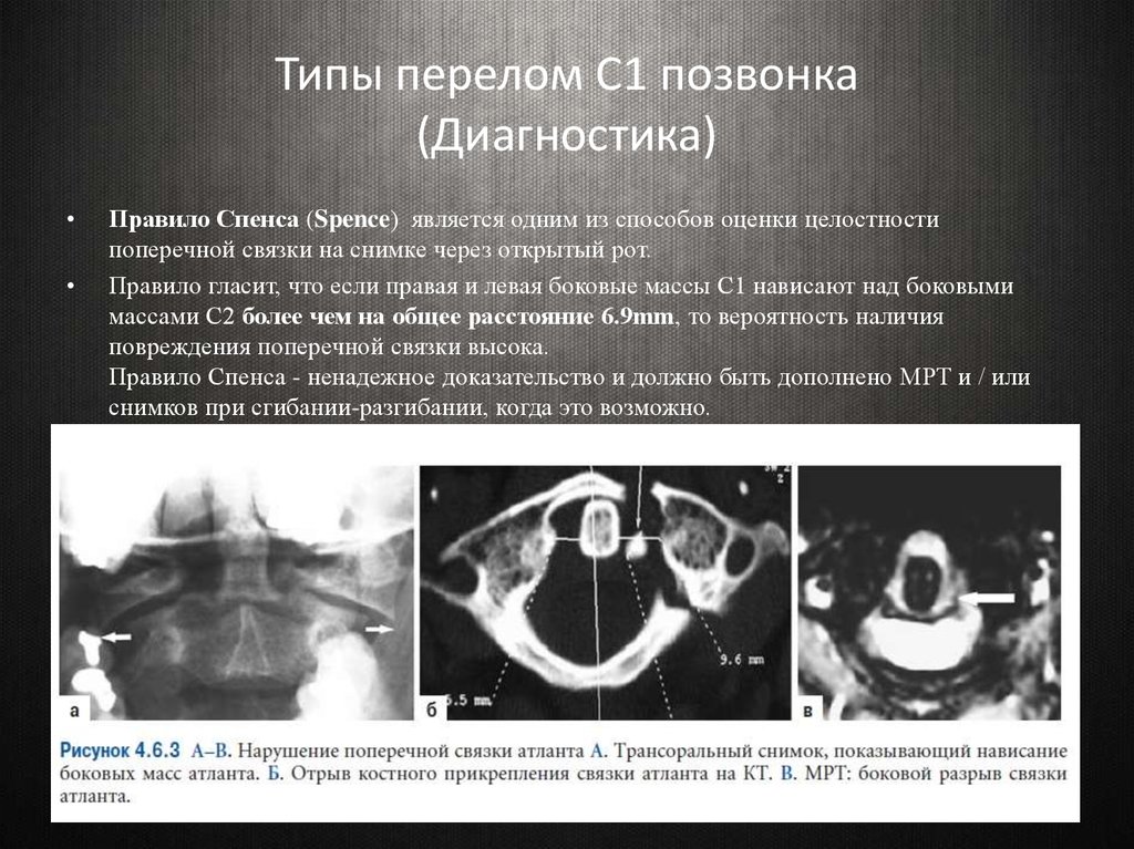 Ротационный подвывих. Ротационный подвывих с1 позвонка рентген описание. Классификация переломов 1 шейного позвонка. Подвывих Атланта кт. Подвывих сустава Крювелье.