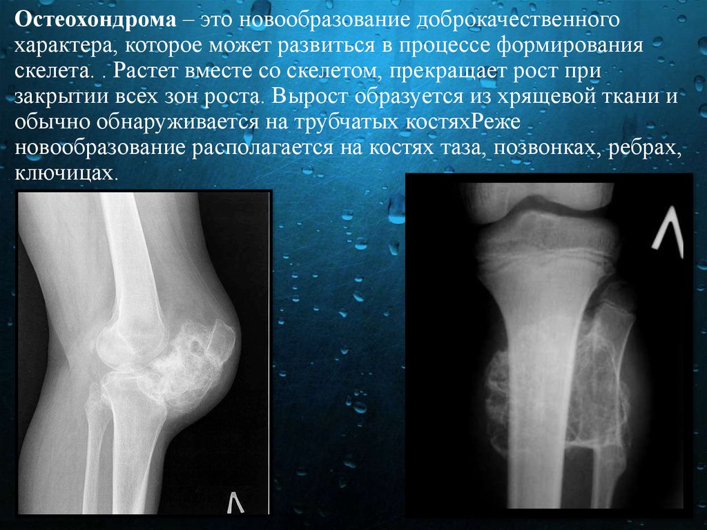 Остеохондрома бедренной. Экхондрома бедренной кости. Остеохондрома большеберцовой кости кт. Остеохондрома малоберцовой кости рентген. Остеохондрома плечевой кости на кт.