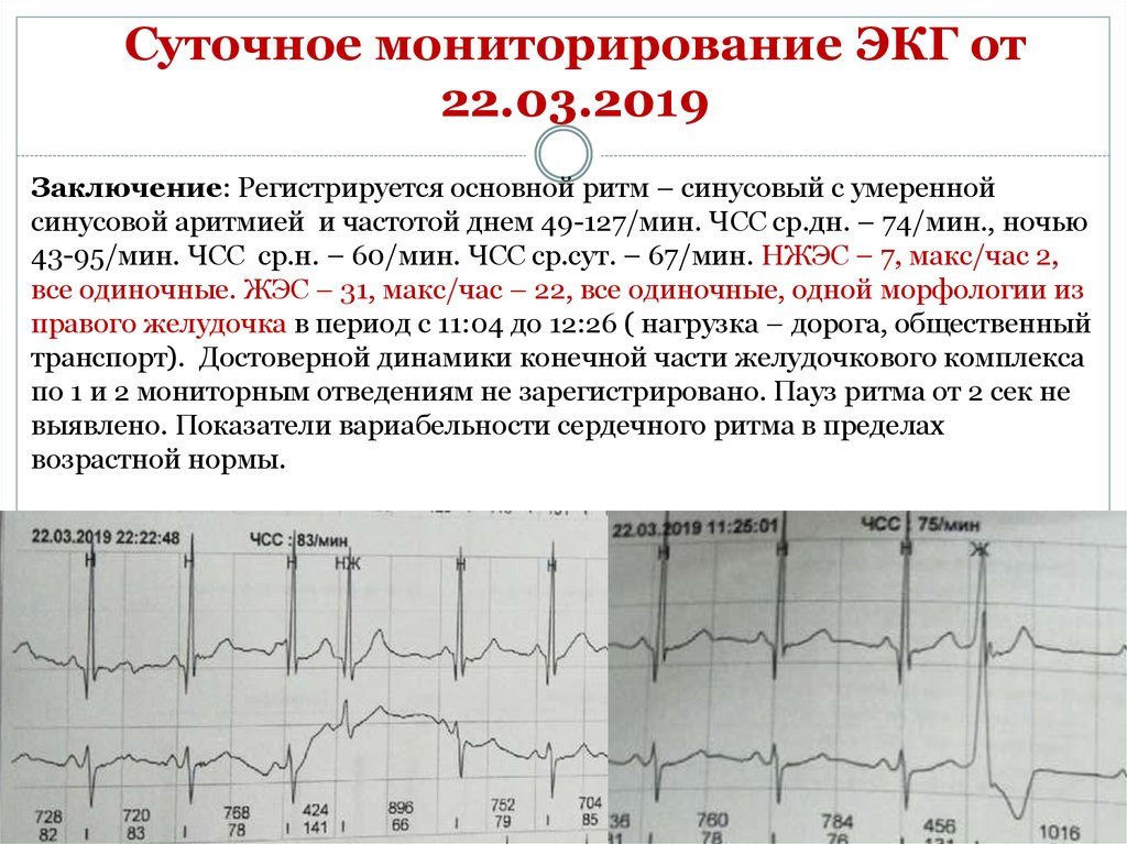 Холтер сколько по времени. ЭКГ нормальные синусовый ритм норма. Кардиограмма сердца заключение синусовый ритм. Ритм синусовая аритмия с ЧСС. ЭКГ Мерцательная аритмия 50 мм.