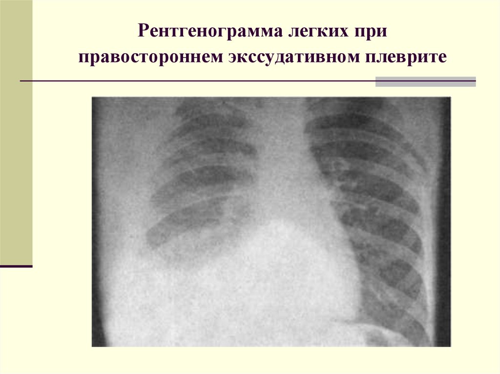 Сухой плеврит рентгенологическая картина