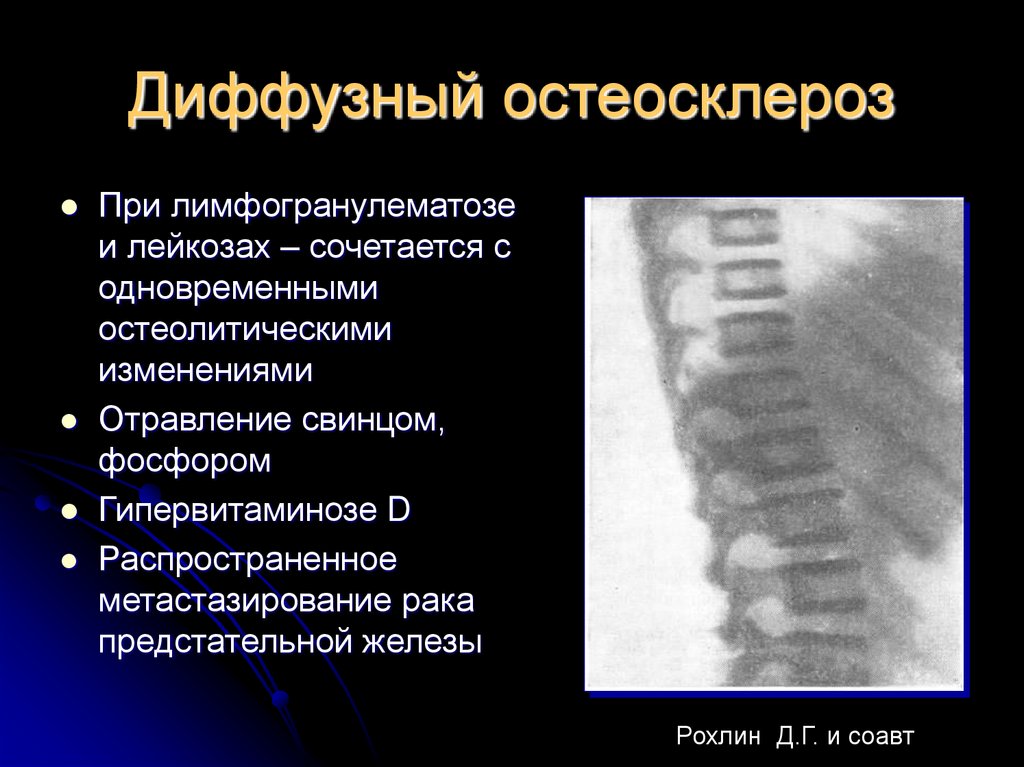 Остеосклеротические очаги в костях