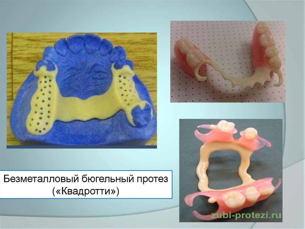 Протез квадротти