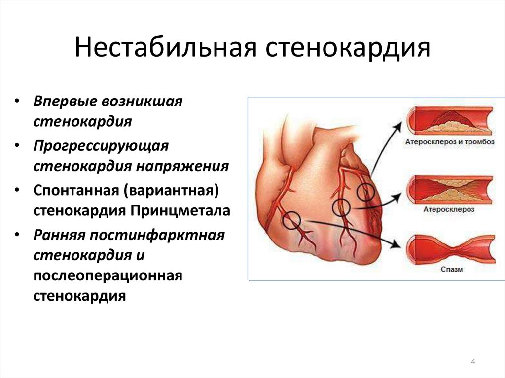 Стабильная ишемическая болезнь сердца презентация