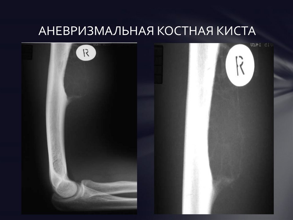 Костная киста. Аневризмальная костная киста рентген. Аневризмальная костная киста кт. Аневризмальная костная киста плечевой кости кт. Аневризмальная киста бедренной кости на кт.