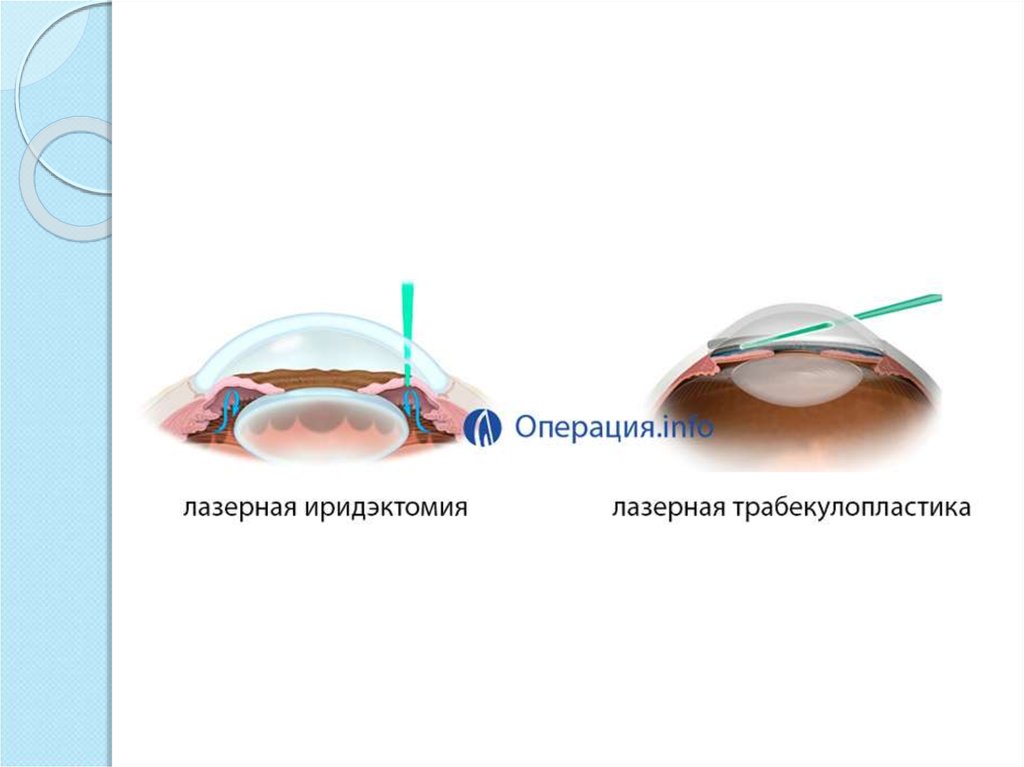 Лазерная иридэктомия. Лазерная трабекулопластика. Операция лазерная иридэктомия. Лазерная чистка глаукомы.