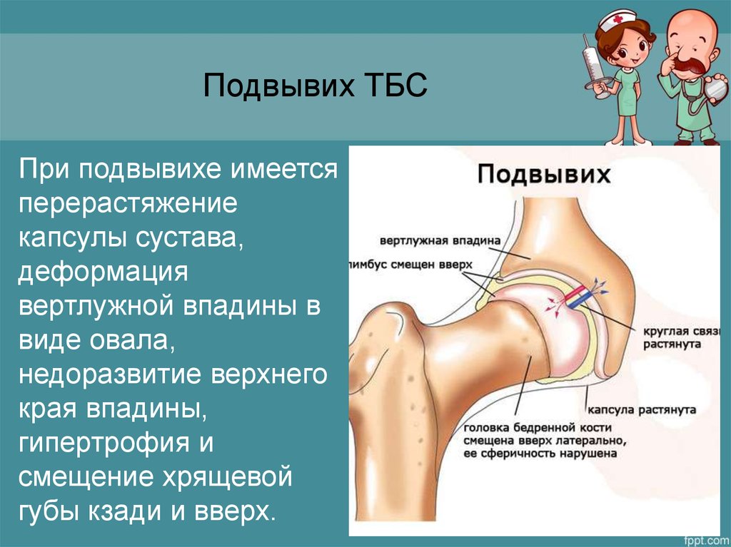 Подвывих. Дисплазия вертлужной впадины тазобедренного сустава. Подвывих бедренной кости.