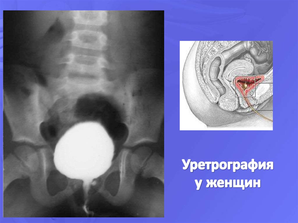 Что такое уретра. Ретроградная уретроцистография. Рентген-контрастная уретрография. Рентген анатомия уретры у мужчин. Ретроградная и микционная уретроцистография.