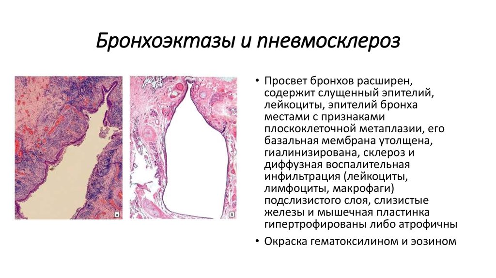 Что такое пневмофиброз легких