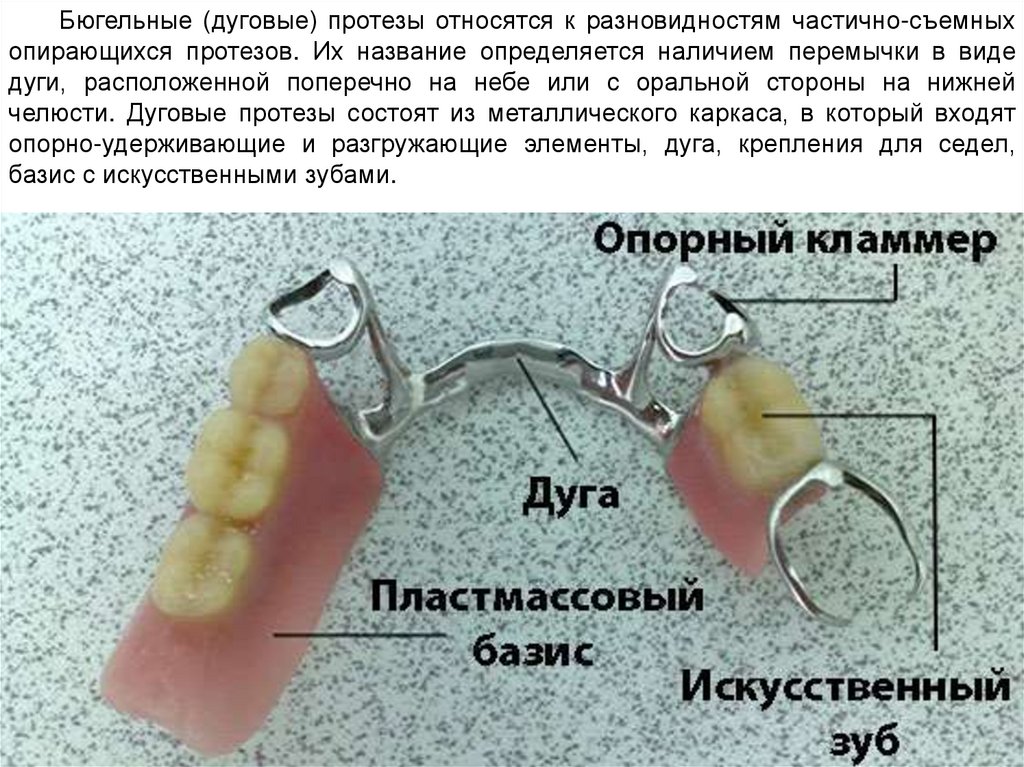 Строение бюгельного протеза. Составные части бюгельных протезов. Составные элементы бюгельного протеза. Основные конструктивные элементы бюгельных протезов. Основные конструктивные элементы бюгельного протеза.