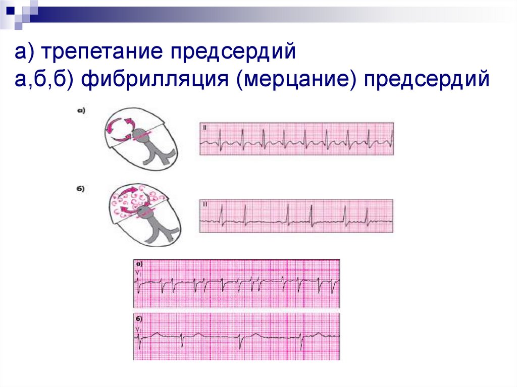 Диагноз постоянная форма фибрилляции предсердий. Различие трепетания и фибрилляции предсердий. Трепетание предсердий патогенез. Мерцание и трепетание предсердий классификация.