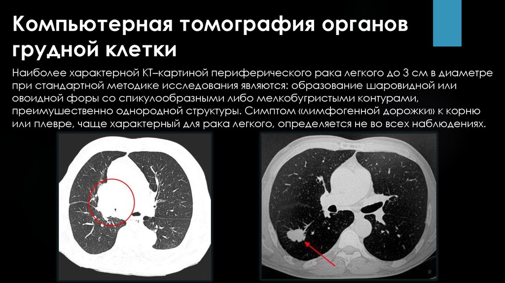 Кт картина краевой деструкции смежных костей наиболее характерна для