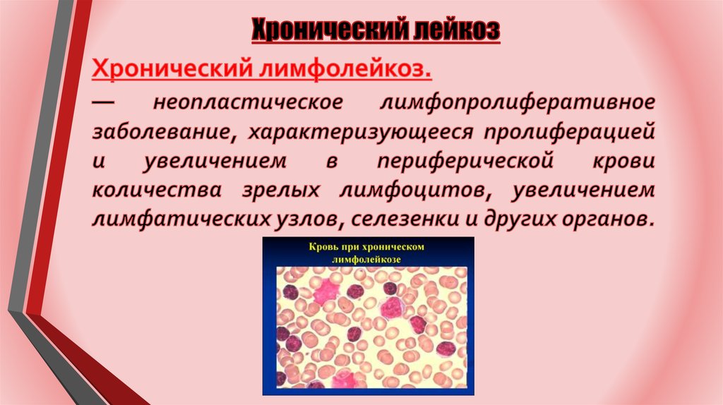 Хронические заболевания крови. В -лимфоциты хронический лимфолейкоз. Острый лейкоз и хронический лимфолейкоз. Хронический лимфолейкоз характеризуется. Хронический лимфолейкоз лимфатические узлы.