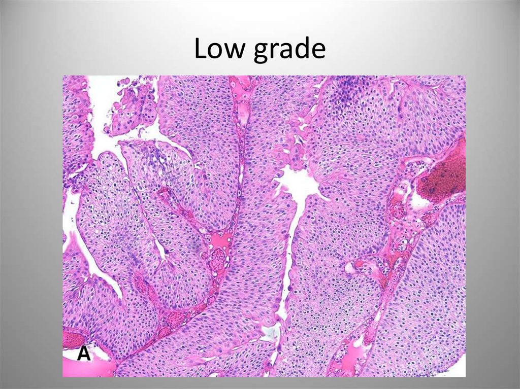 Карцинома low grade мочевого. Уротелиальная карцинома мочевого пузыря микропрепарат. Уротелиальная карцинома мочевого пузыря гистология. Уротелиальная карцинома гистология.