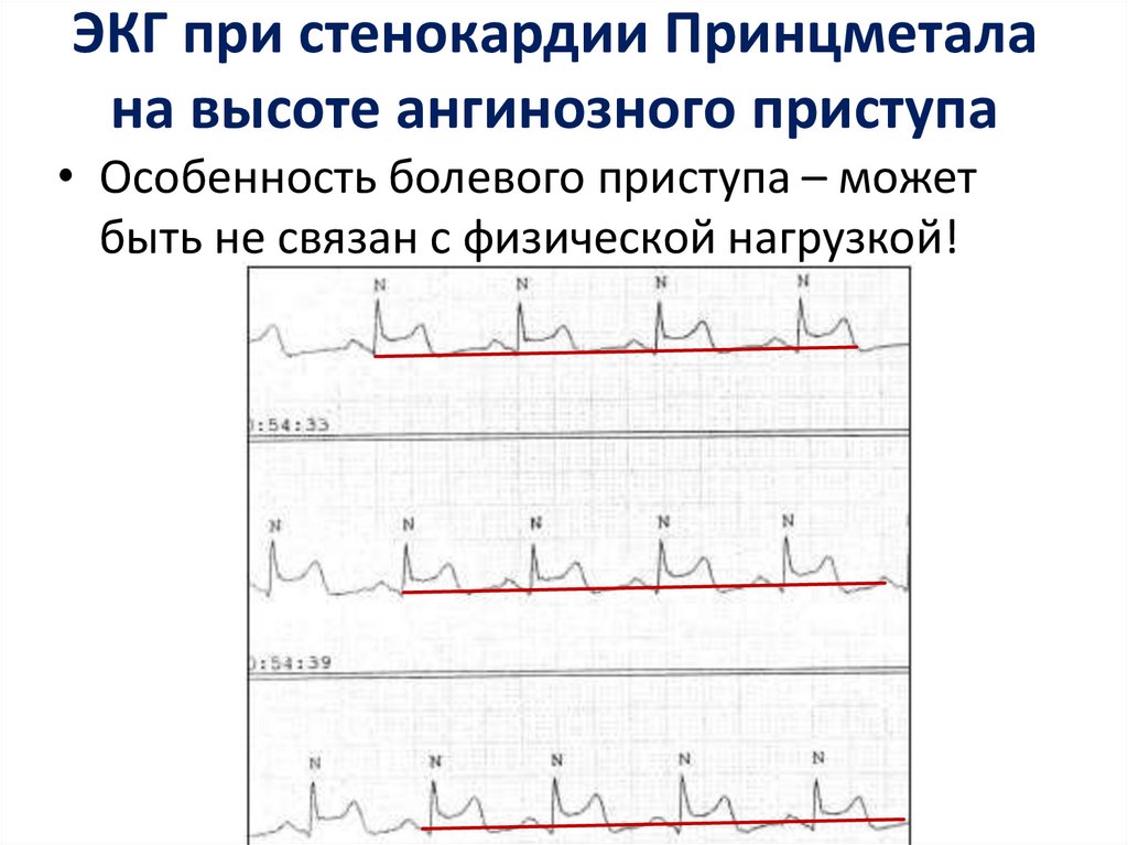 Вариантная стенокардия принцметала. ИБС стенокардия напряжения ЭКГ. Нестабильная стенокардия ЭКГ. Стенокардия Принцметала на ЭКГ. ЭКГ признаки ИБС И стенокардии.